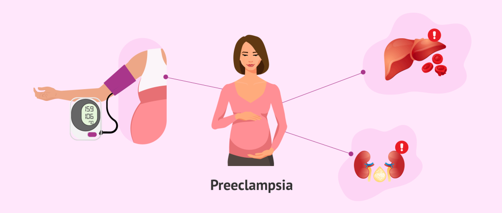 Preeclampsia nightmare for women